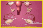 Cơ chế hình thành và Nguyên nhân gây bệnh U nang buồng trứng