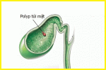 Polyp trong túi mật có nguy hiểm không?