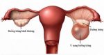Những điều bạn cần biết về u nang buồng trứng